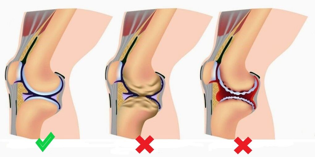 Depanten verhindert die Entwicklung von Arthritis und Osteoarthritis