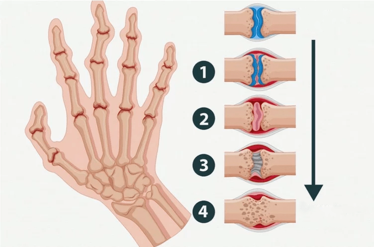 Stadien der rheumatoiden Arthritis, die die Fingergelenke betreffen. 