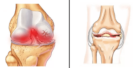 Arthritis Arthrosevergleich