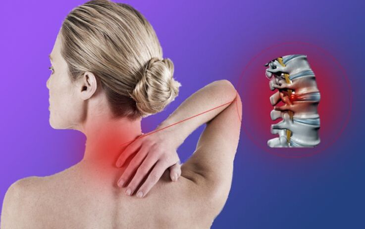 Entzündung der Säule mit zervikaler Osteochondrose