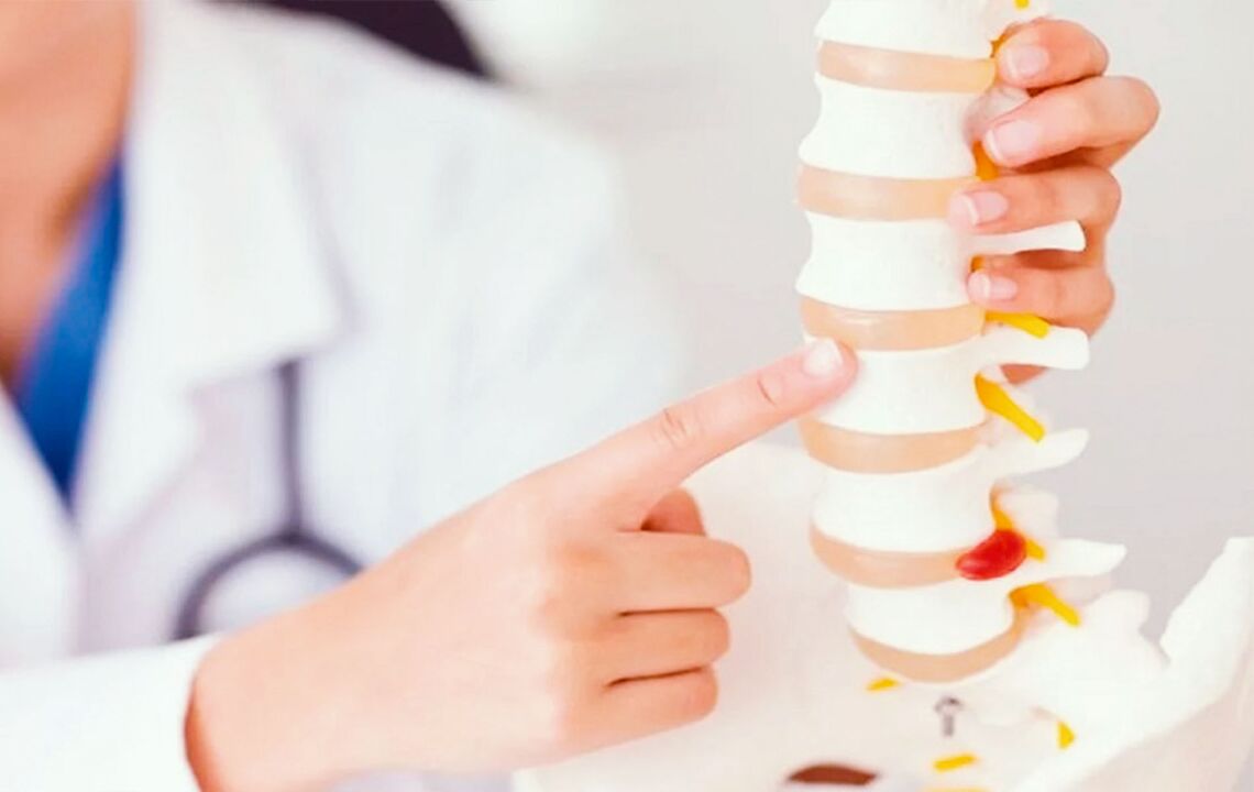 Schädigung der Wirbelsäule durch zervikale Osteochondrose.
