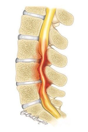 Bei einer Osteochondrose der Brustwirbelsäule kommt es zu einer Kompression des Wirbelkanals.