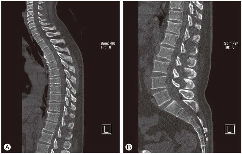 Deformation der Bandscheiben auf Magnetresonanzbildern bei thorakaler Osteochondrose