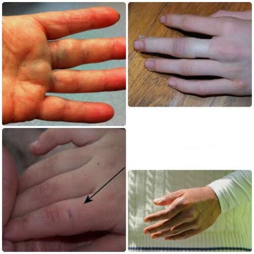 Prellungen und Brüche der Finger sind durch Schmerzen und Schwellungen in den Gelenken gekennzeichnet.