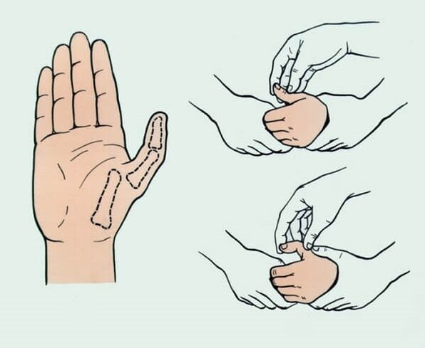 Reposition eines ausgerenkten Fingers, notwendig zur Beseitigung von Gelenkschmerzen.