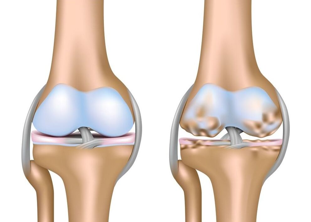Verschlimmerung der Arthrose der Gelenke.
