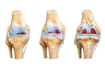 Entwicklungsstadien einer Arthrose des Kniegelenks