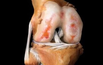 Was ist Arthrose des Kniegelenks
