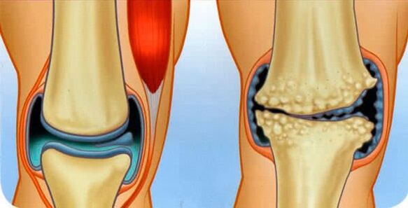 gesundes Gelenk und Arthrose des Gelenks