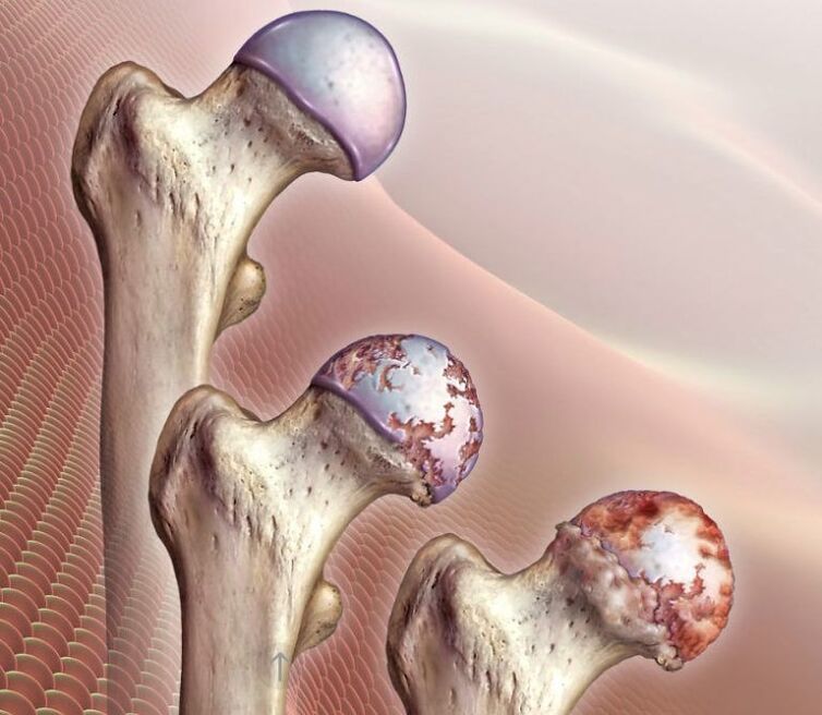 Arthrose des Hüftgelenks in unterschiedlichem Ausmaß. 