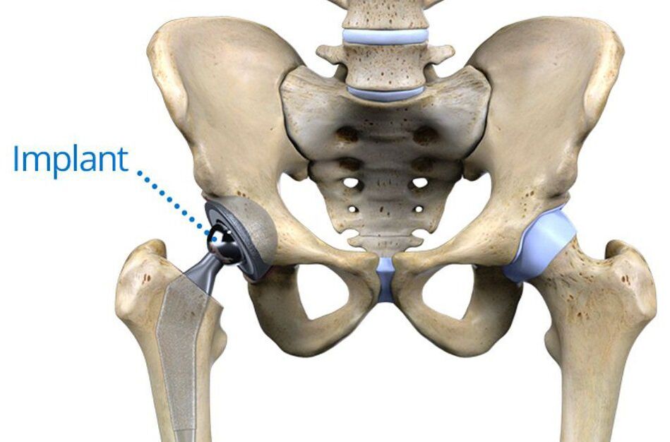 Hüfttotalendoprothetik bei Arthrose