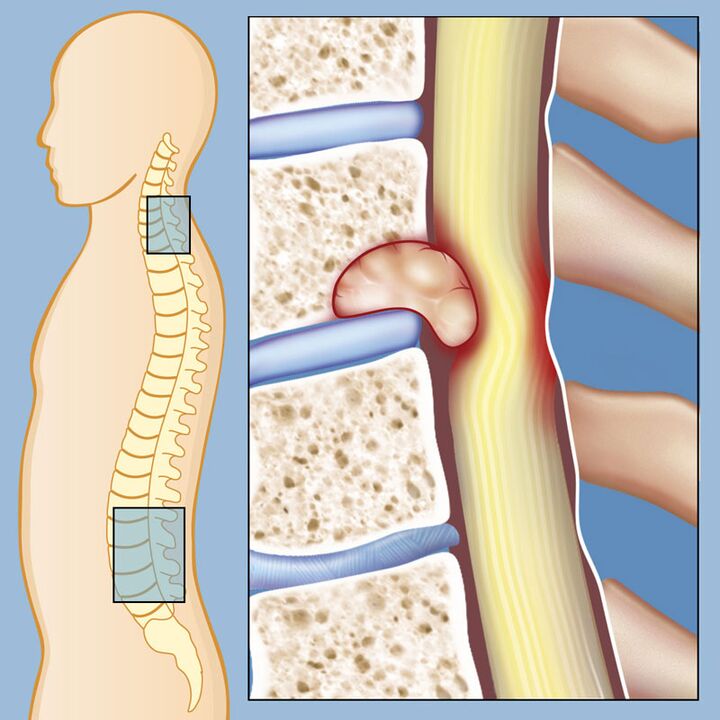 Bösartiger Tumor als Ursache für starke Rückenschmerzen